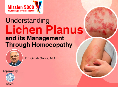 Understanding Lichen Planus and its Management Through Homoeopathy